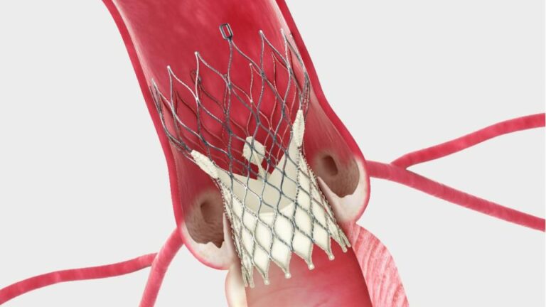 TAVR